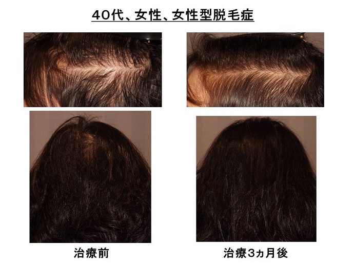 円形脱毛症　病院""
